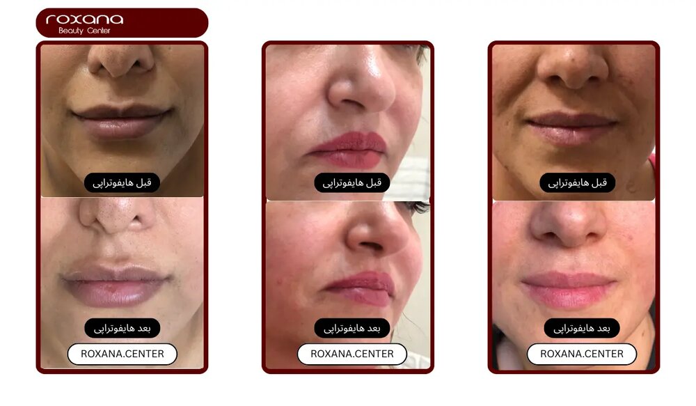 هایفوتراپی صورت