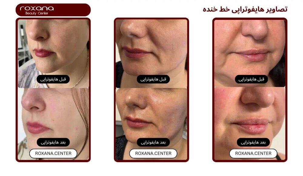 هایفوتراپی