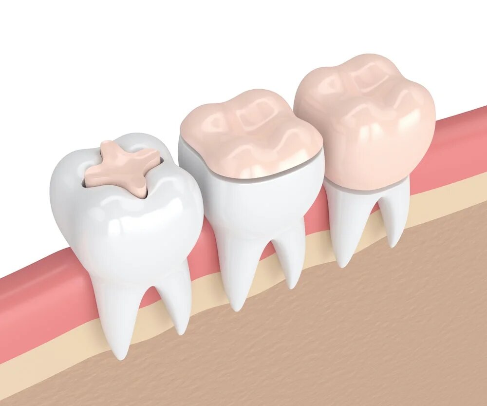 Dental Filling vs. Crown: Which is Right For Me?