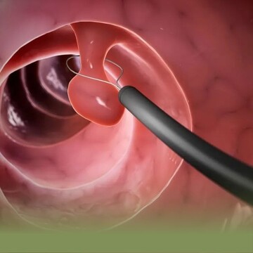کولونوسکوپی چیست و چگونه انجام میشود؟