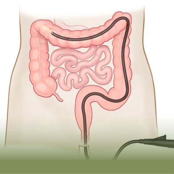 کولونوسکوپی چگونه انجام میشود؟