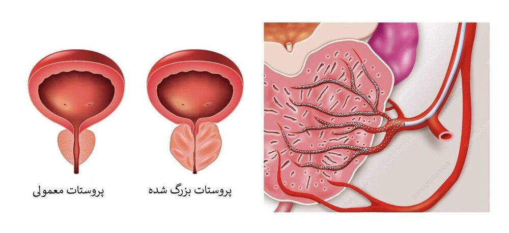 علت ابتلا به پروستات چیست و چرا با افزایش سن شایع تر می شود؟