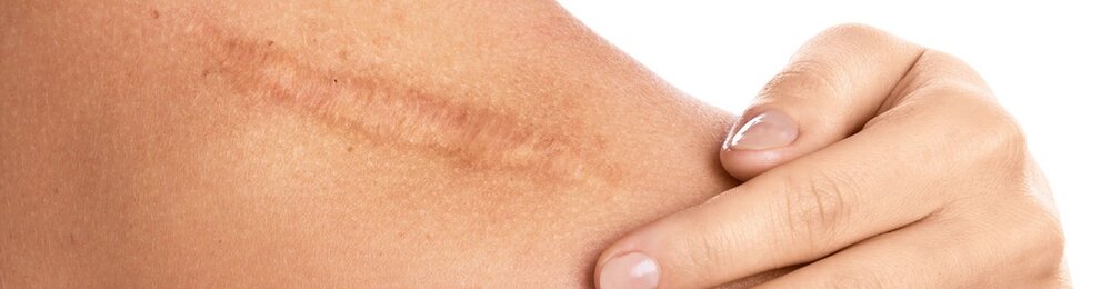 لیزر موهای زائد پوست آسیب دیده