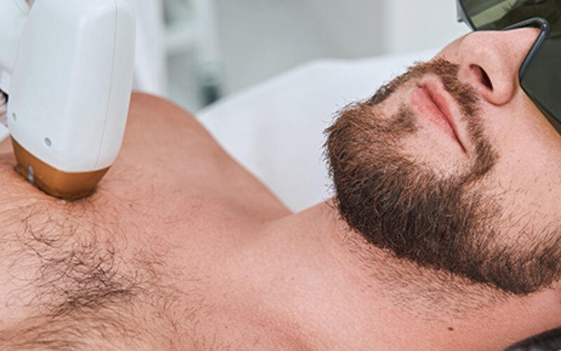 روش های جدید برای لیزر موهای زائد