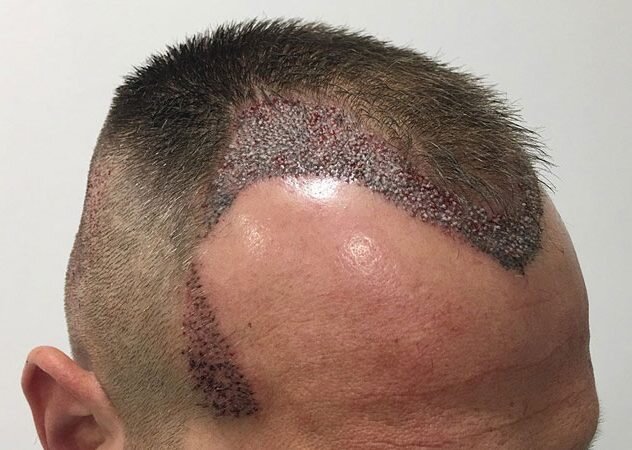 آشنایی با روشهای کاشت مو