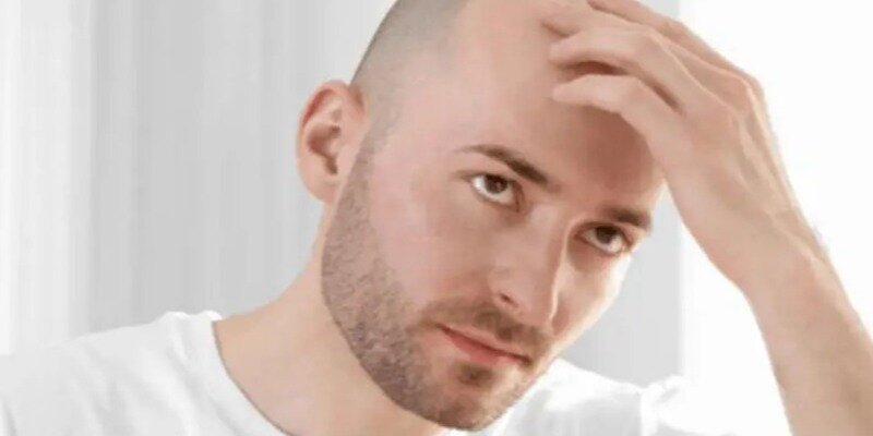 آشنایی با روش‌های کاشت مو