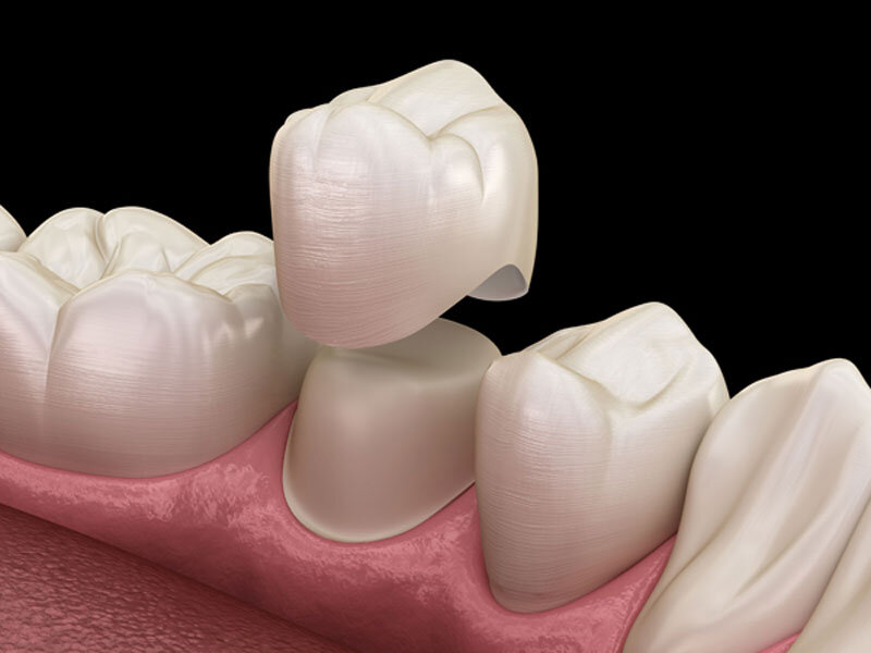 هزینه روکش دندان ۱۴۰۴ + لیست قیمت
