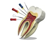 برای درمان ریشه و عصب کشی دندان چه ابزاری نیاز است؟