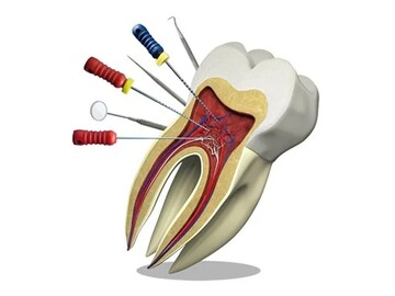 برای درمان ریشه و عصب کشی دندان چه ابزاری نیاز است؟