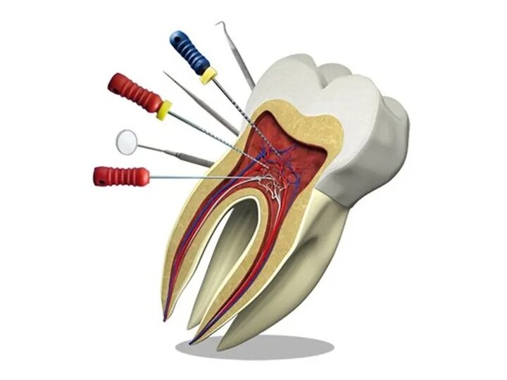 برای درمان ریشه و عصب کشی دندان چه ابزاری نیاز است؟