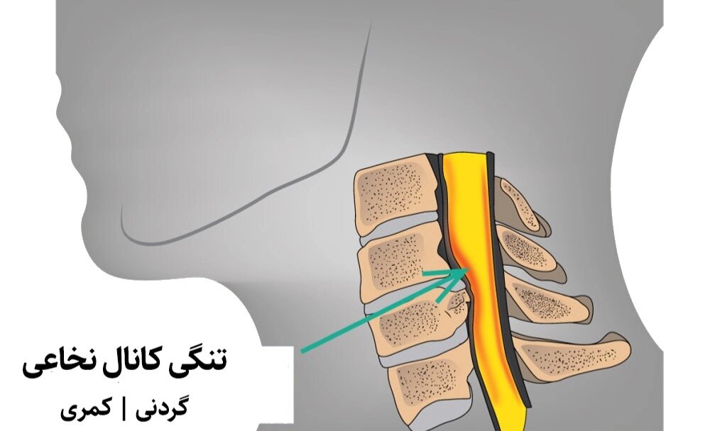 آیا تنگی کانال نخاعی دارید؟ | تشخیص، درمان و انتخاب روش جراحی آیا تنگی کانال نخاعی دارید؟ | تشخیص، درمان و انتخاب روش جراحی