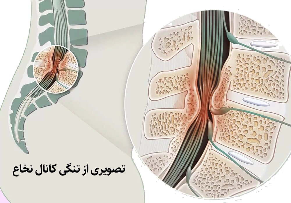 تنگی کانال نخاعی