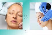 هایفوتراپی بهتر است یا اندولیفت؟ (مقایسه ماندگاری، درد و عوارض)