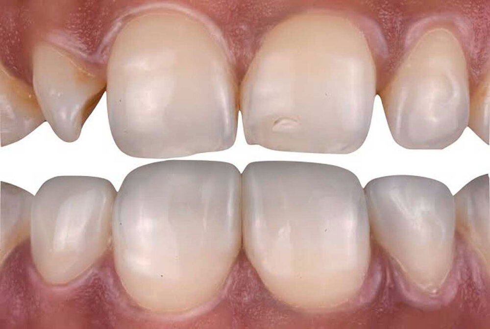 نمونه کار طرح لبخند با کامپوزیت