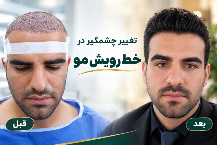کاشت مو به صورت طبیعی
