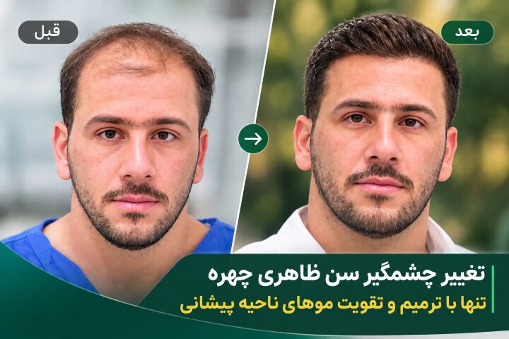 مقایسه نمای میکروسکوپی و گرافیکی تراز طبیعی خط رویش؛ چیدمان نامنظم و مویرگی تارهای تک‌فولیکولی در برابر خطوط مستقیم و غیرطبیعی که ظاهر را مصنوعی می‌کنند
