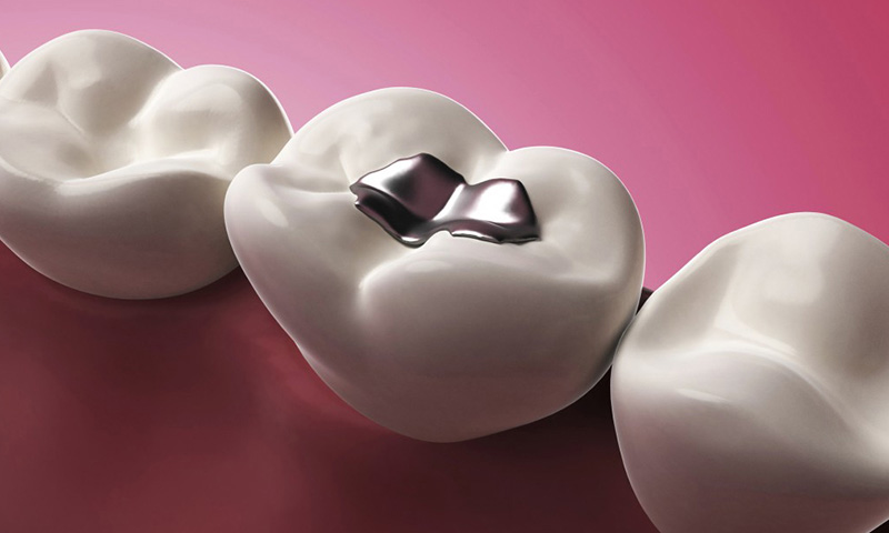 آمالگام و کاربرد آن در دندانپزشکی
