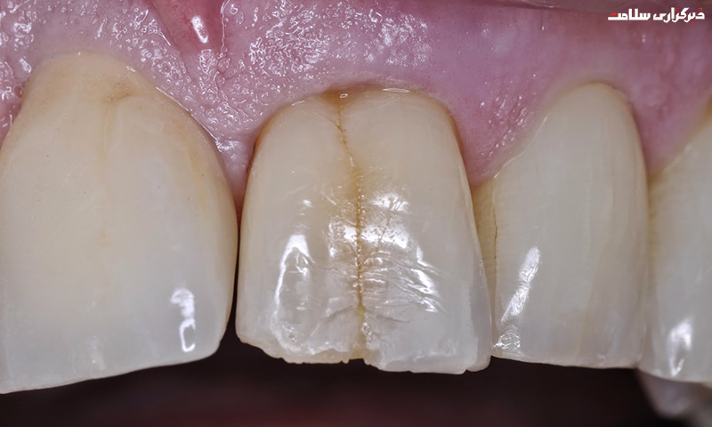 مشکلات ناشی از ترک دندان