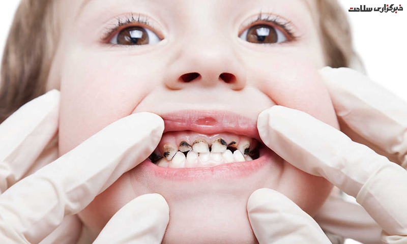 پوسیدگی دندان کودکان و راهکارهای جلوگیری از آن