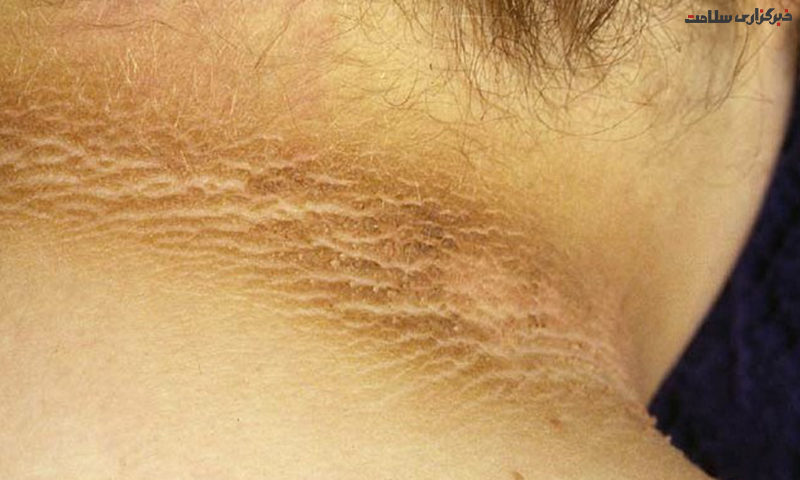 علل ابتلا به اختلال پوستی آکانتوز نیگریکانس