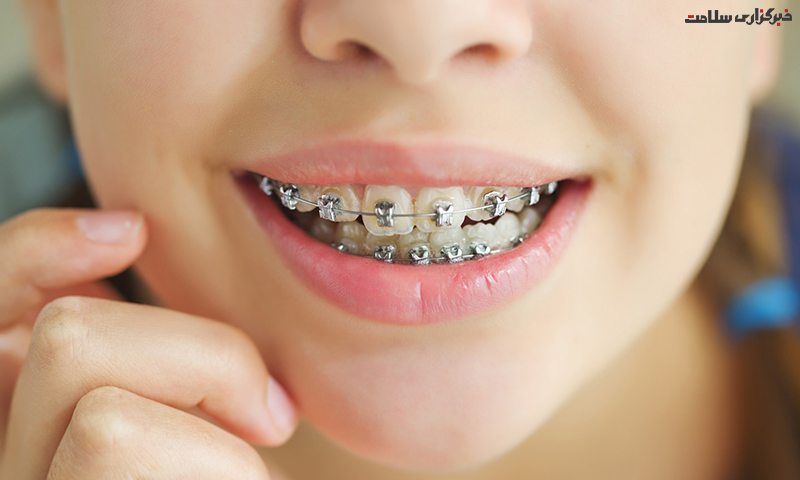 ارتودنسی ثابت دندان; مزایا و معایب