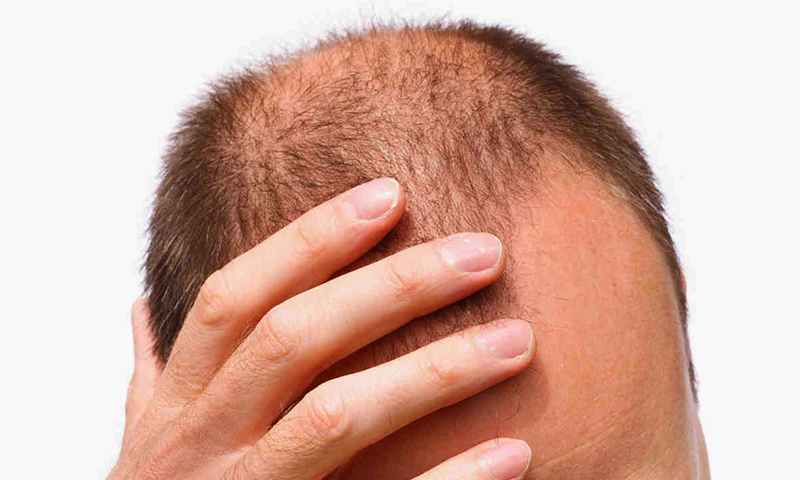 ریزش مو در مردان و روش‌های درمان آن