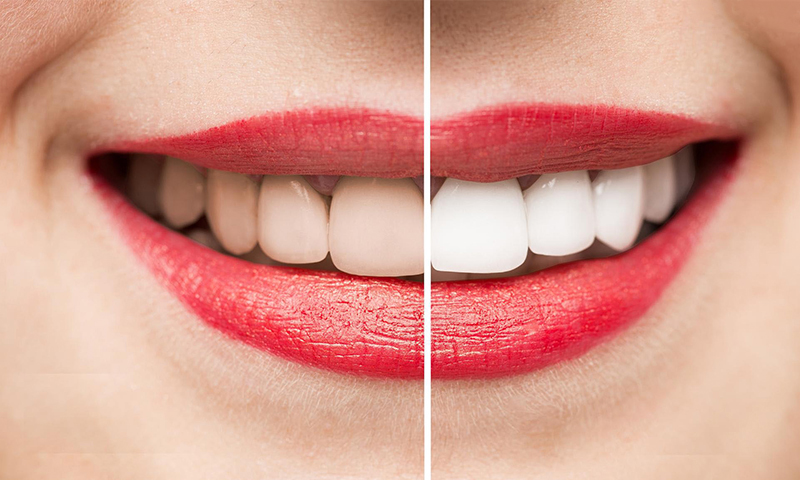 درباره ترمیم زیبایی دندان چه میدانید؟