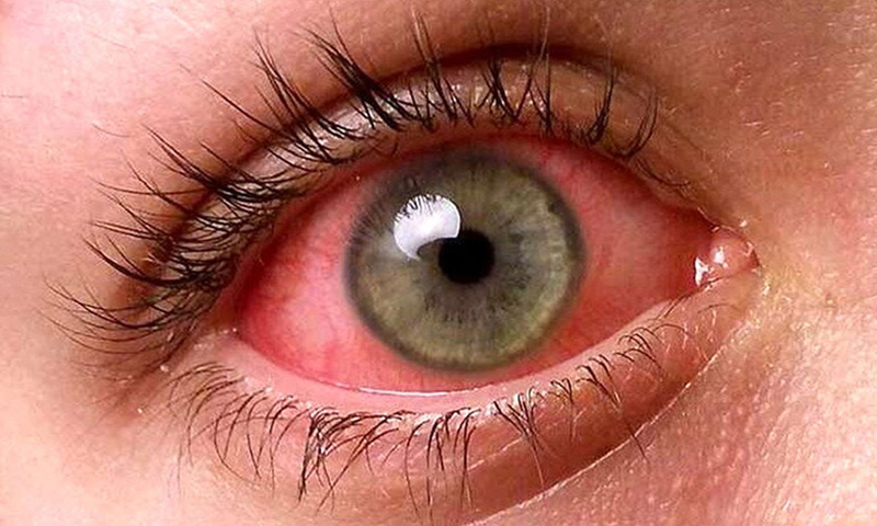 علائم آلرژی چشم و روش های پیشگیری از آن