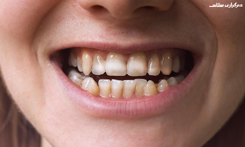 روش‌های درمان لکه‌های سفید روی دندان