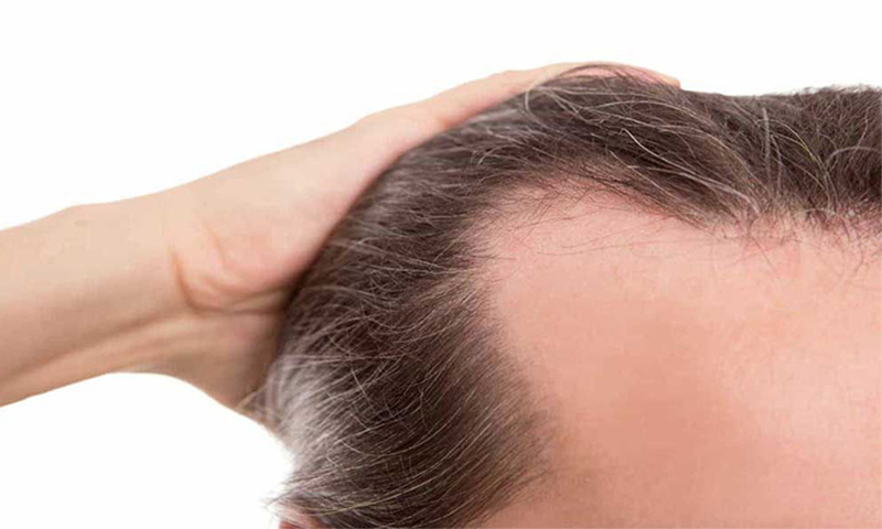 شایع ترین علت های ریزش مو را بشناسید