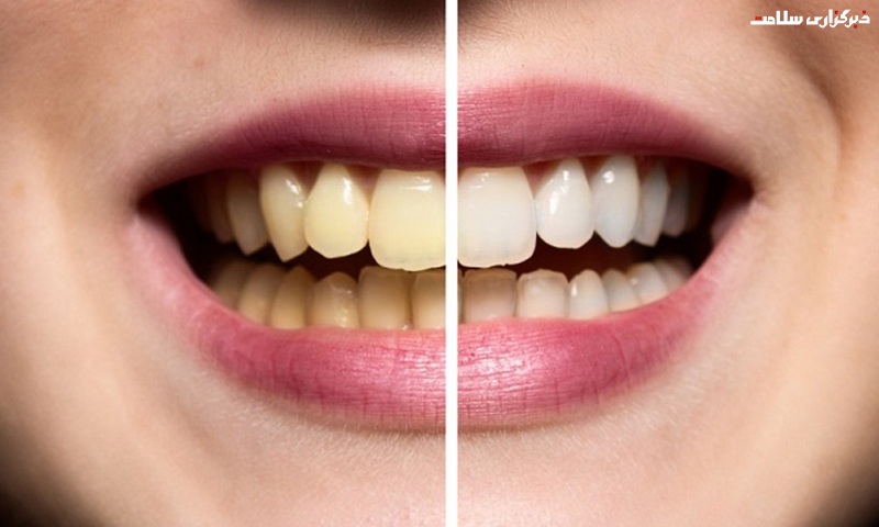 علت بد رنگ شدن دندان و درمان آن