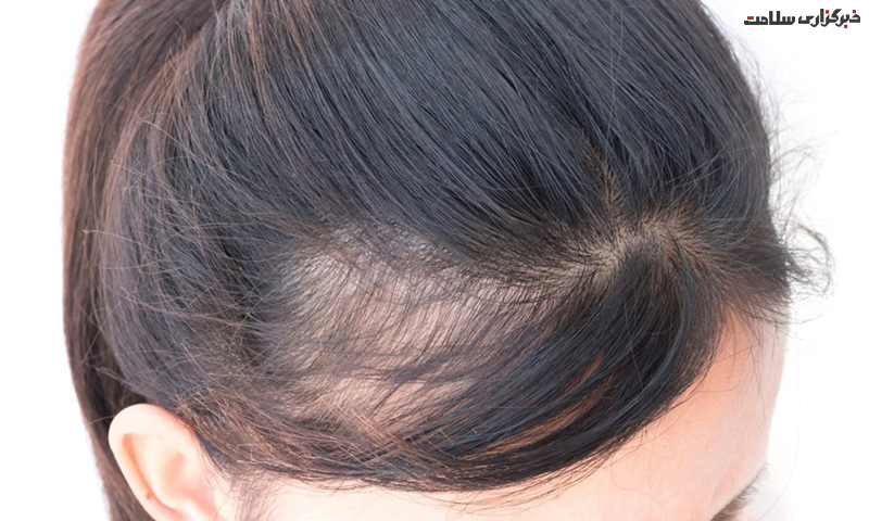 علل ریزش موی سر در زنان و روش‌های درمان آن