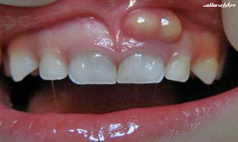 علائم آبسه دندان و روش درمان آن