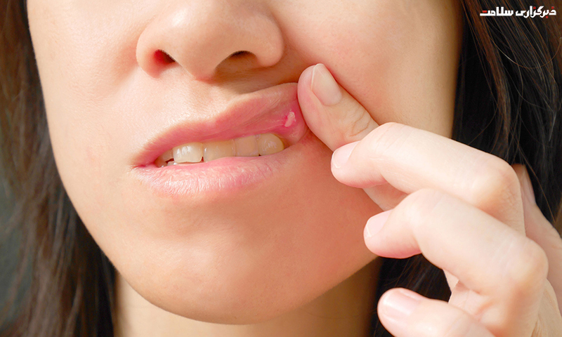 درمان افت دهان با داروهای گیاهی