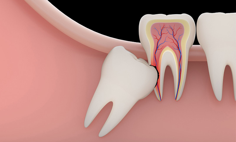 درد دندان عقل و روش های درمان آن