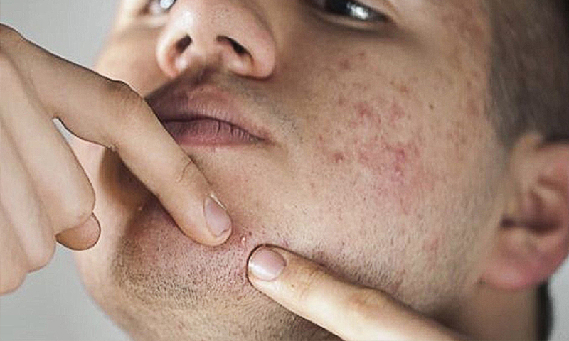 چرا جوش می‌زنیم؟