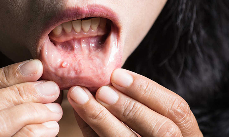 سرطان دهان: هر آنچه باید درباره این بیماری بدانید!