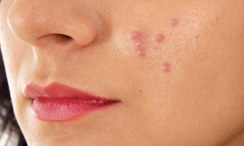 از ارتباط بین آکنه‌های پوستی با قند و شکر چه می‌دانید؟