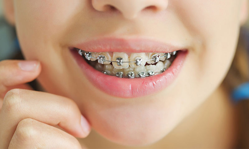 در ارتودنسی کدام دندان را می‌کشند؟