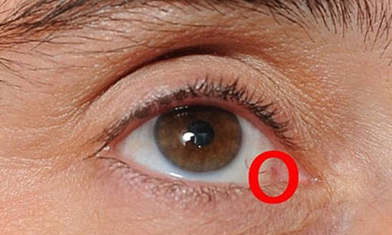 علائم و روش های درمان سرطان چشم