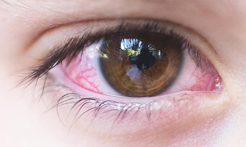 روش های جلوگیری از آلرژی چشمی