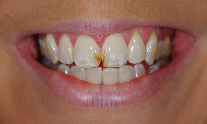 لکه‌های قهوه‌ای رنگ روی دندان را چگونه از بین ببریم؟