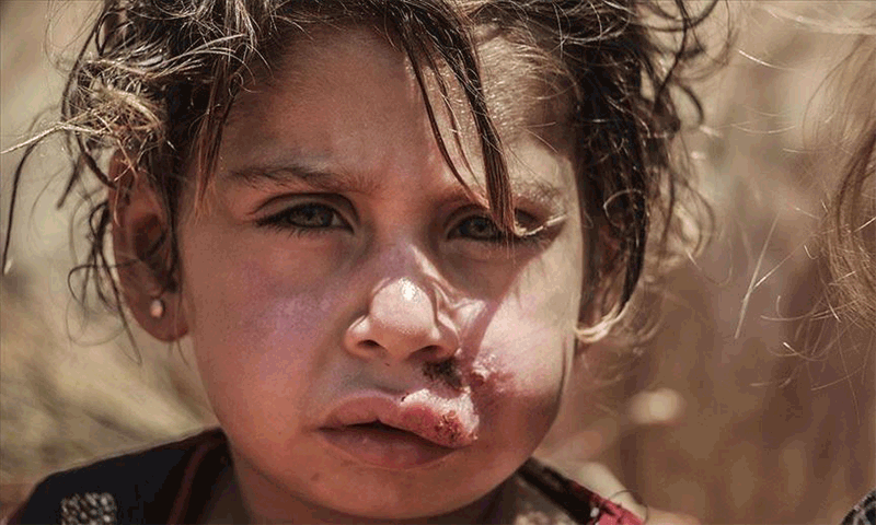 شیوع بیماری سالک بین آوارگان در اردوگاه‌های ادلب سوریه