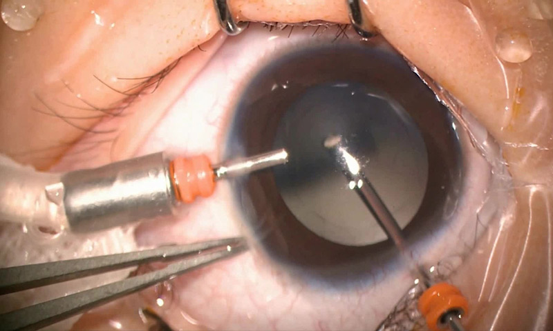 بهبود بینایی با عمل ویترکتومی