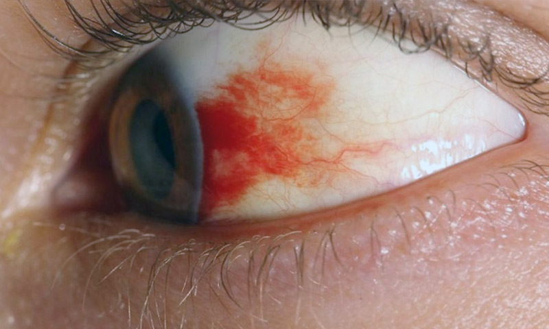 دلایل و روش های درمانی  لکه خونی در چشم