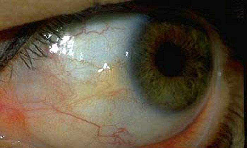 علت وجود انواع لکه‌ها در چشم چیست؟ / پینگوکولای پهن قابل درمان نیست