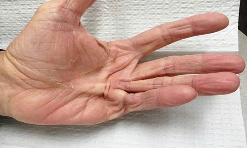 دوپویترن یا بیماری کف دست چیست؟