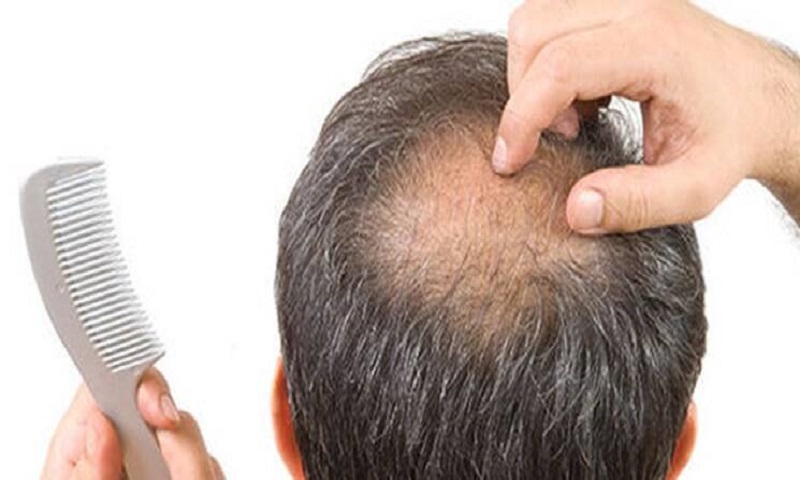ریزش موی شدید از عوارض کووید 19 است