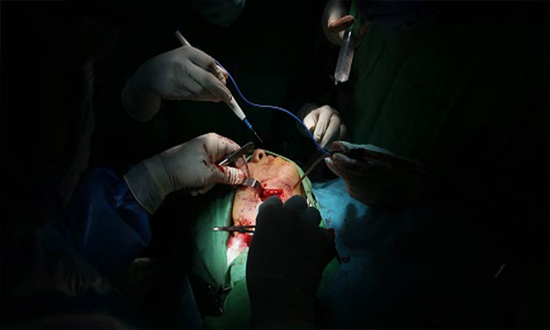جراحی موفقیت آمیز تخلیه غده بزاقی تحت فکی  زیر سایه کرونا