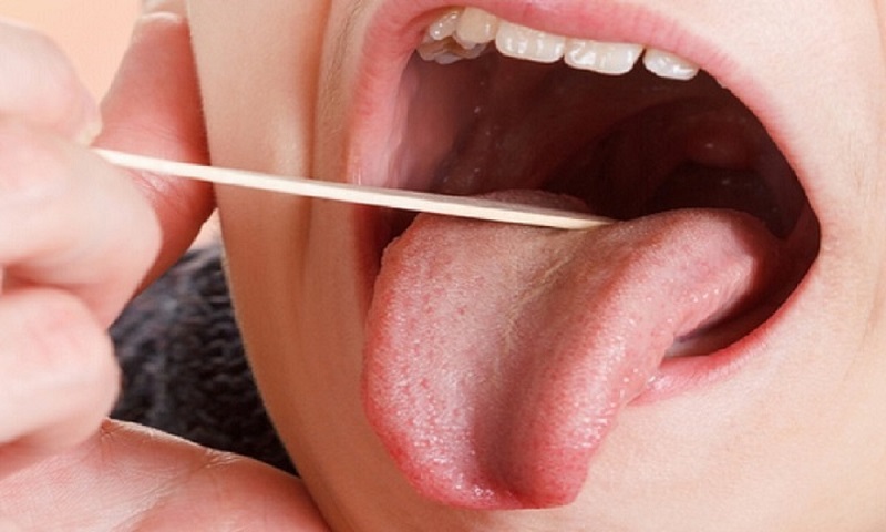 استرس یکی از دلایل خشکی دهان است/خشکی دهان باعث پوسیدگی دندان‌ها می‌شود